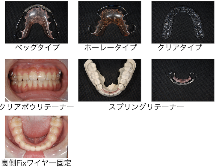 リテーナーの種類 ブログ 美しい歯を手に入れるなら自由が丘シーズ歯科 矯正歯科