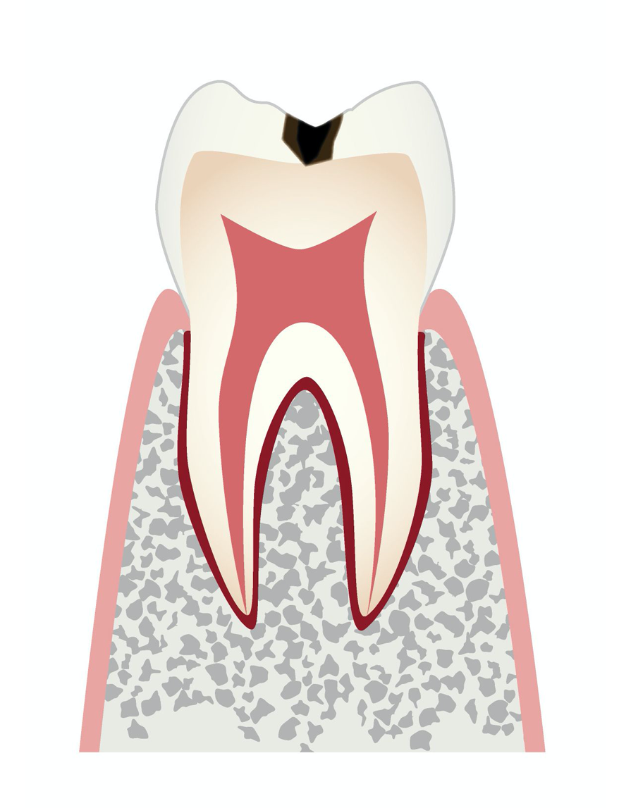 C2：初期の虫歯、エナメル質内の虫歯