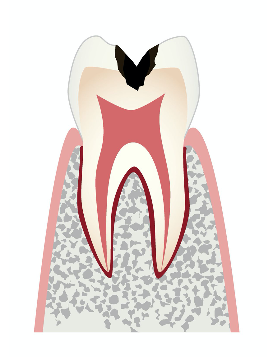 C3：中期の虫歯、象牙質内の虫歯