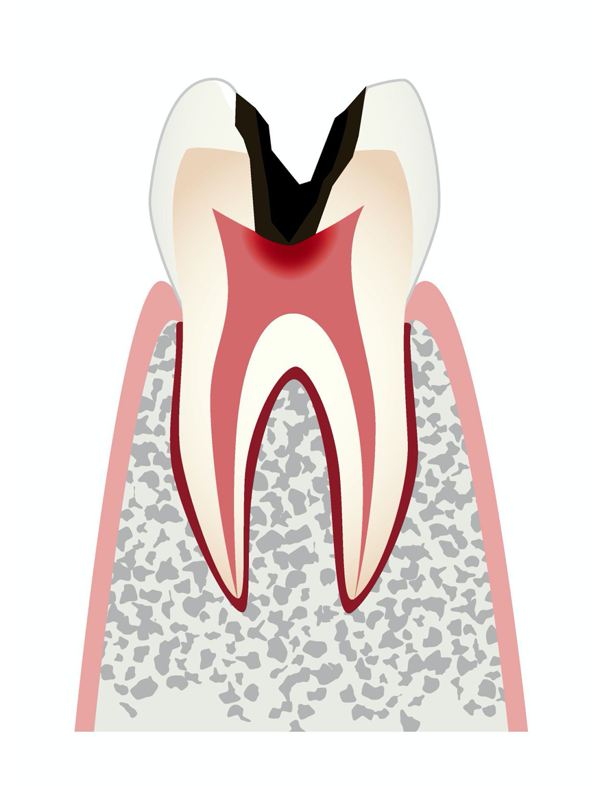 C4：後期の虫歯、歯髄炎（歯の神経の炎症）