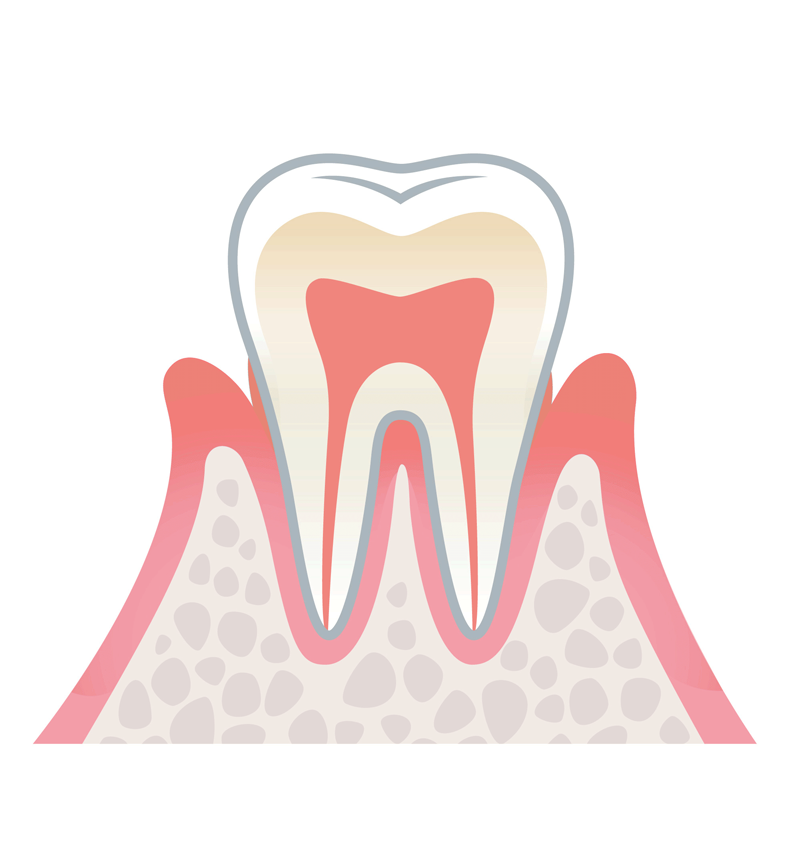 軽度の歯周病