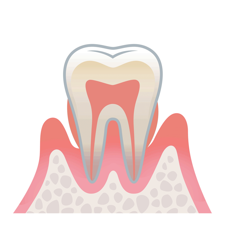 中度の歯周病