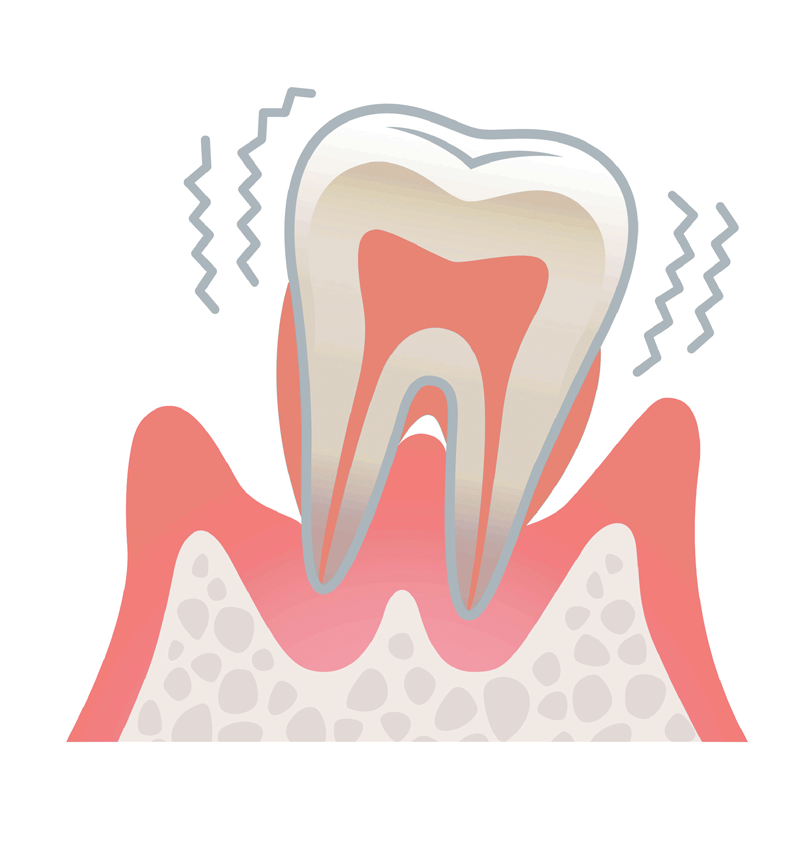 重度の歯周病