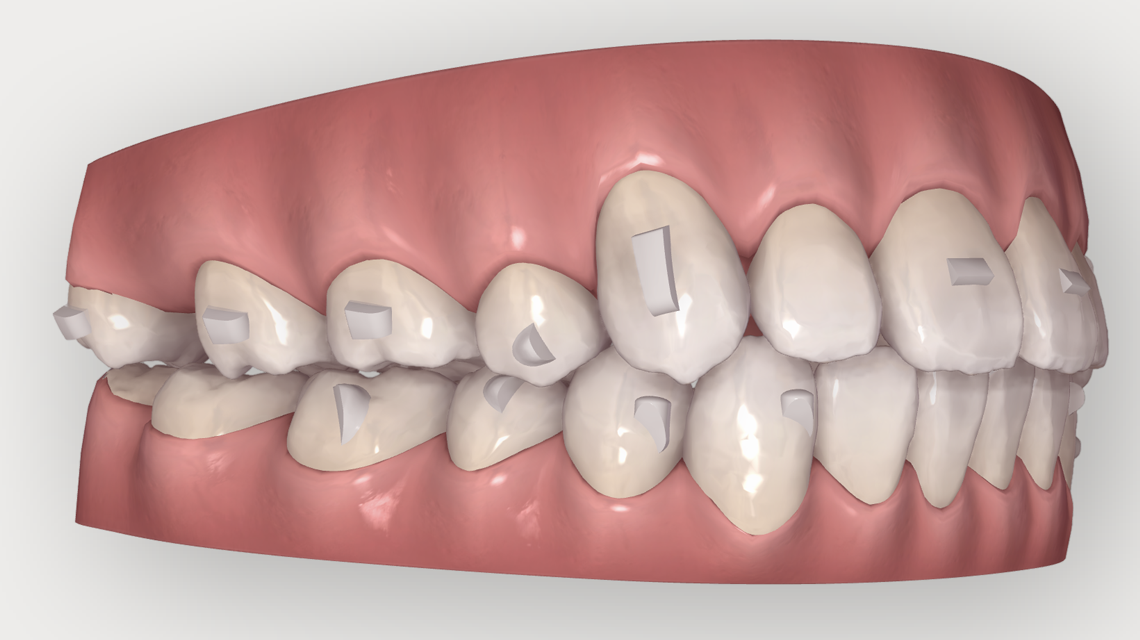 3Dデジタル矯正｜美しい歯を手に入れるなら自由が丘シーズ歯科・矯正歯科